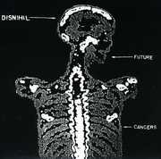 Future Cancers , Disnihil